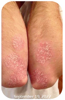 SPRAY ALIVIO PSORIASIS KOLMAX: Adiós a la Picazón