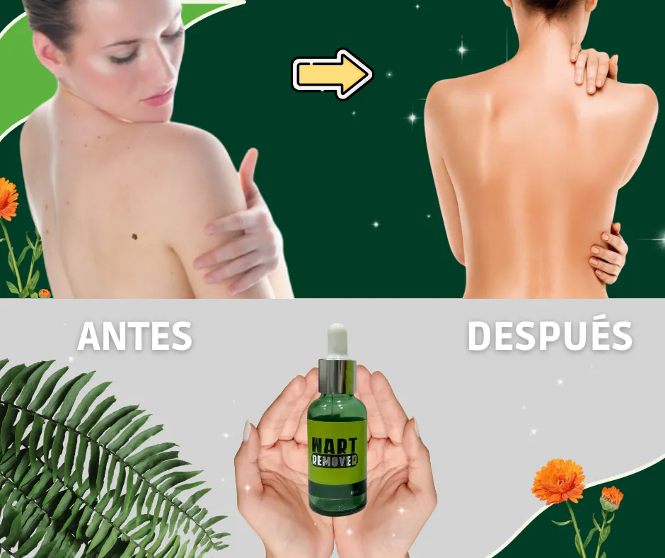 Eliminador de Verrugas Natural - ¡Dile Adiós a las Verrugas! - Eliminador de Verrugas