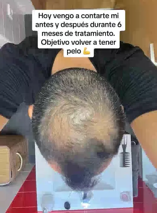 Tratamiento Completo Contra la Caída del Cabello
