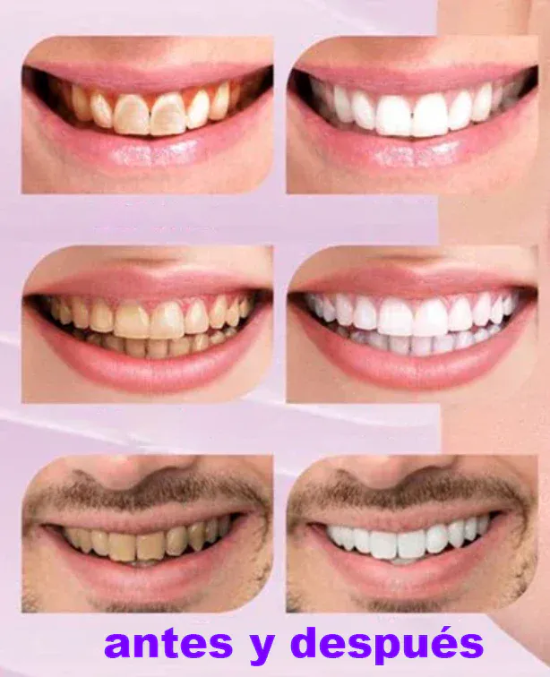 Smilekit espuma morada blanqueadora: ¡Di adiós a las manchas y a las sonrisas amarillas! - Smilekit espuma morada blanqueadora (3)