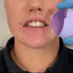 La Revolución del Blanqueamiento Dental