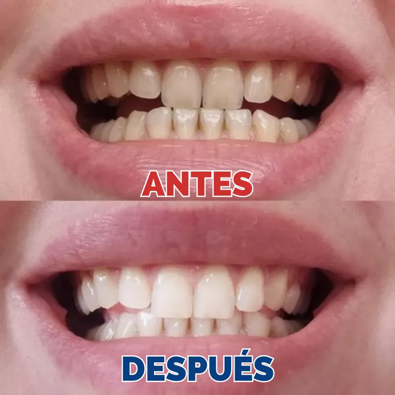 Lápiz Blanqueador de Dientes: ¡Sonríe con Confianza!