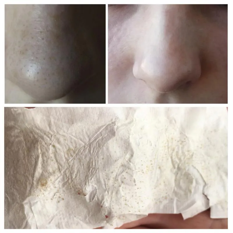 Mascarilla Puntos Negros Lanbena: Piel Radiante y Libre de Imperfecciones - Mascarilla Puntos Negros