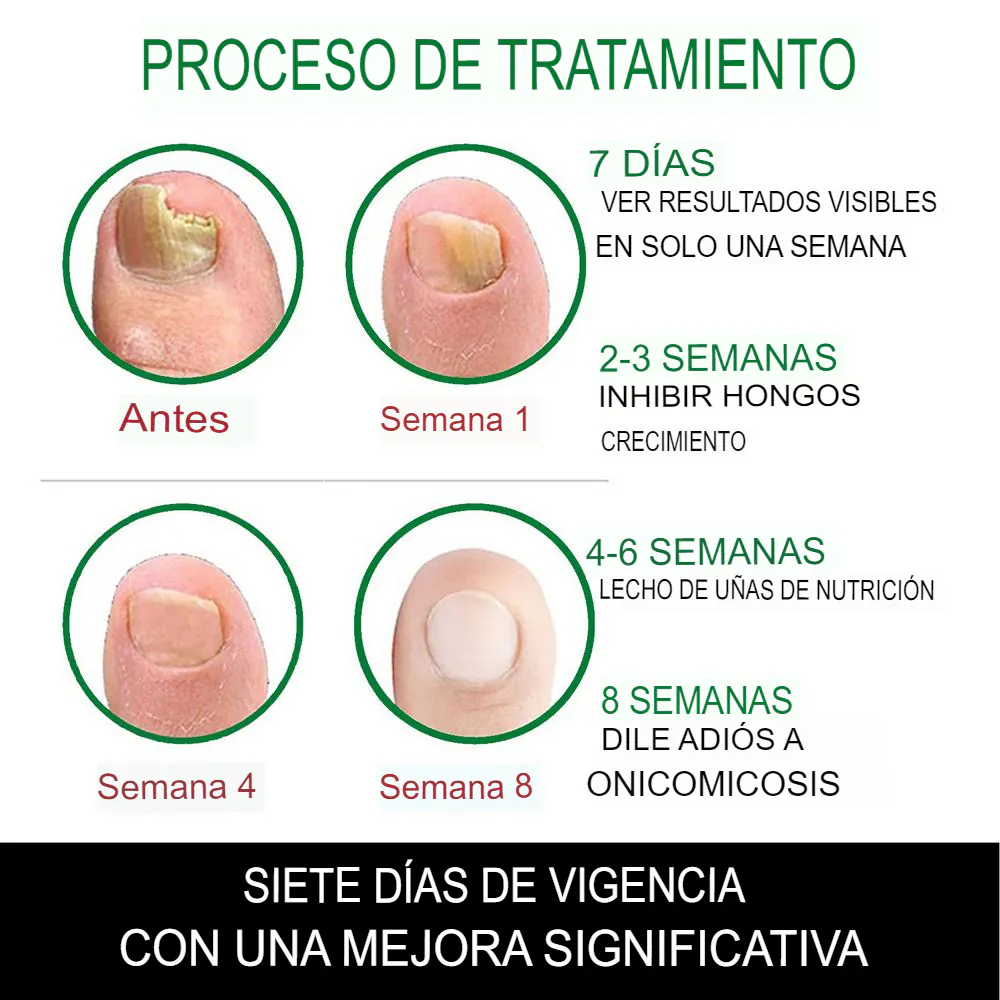 Aceite de Jengibre para Uñas: La Solución Natural para Uñas Saludables - Aceite Jengibre Uñas
