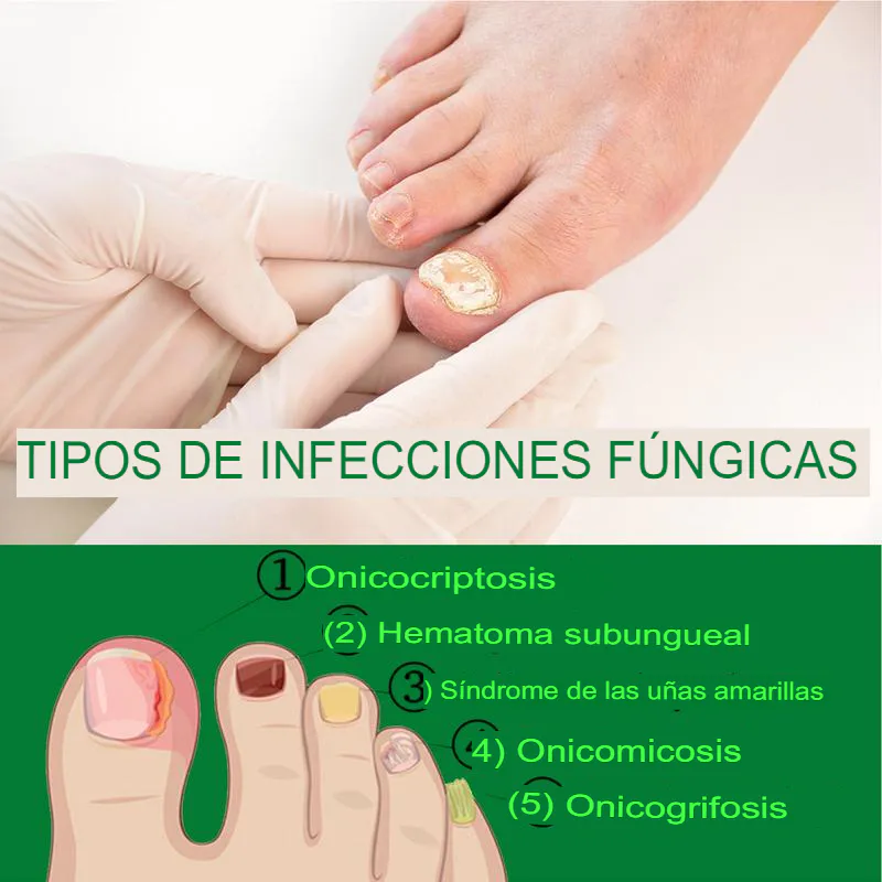 Aceite de Jengibre para Uñas: La Solución Natural para Uñas Saludables - Aceite Jengibre Uñas