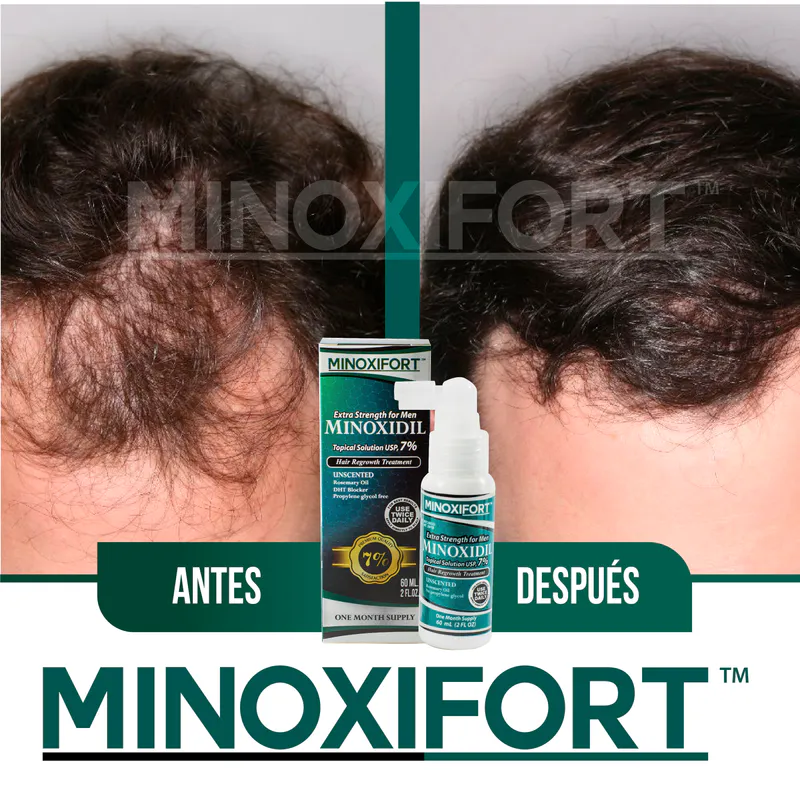 Presentamos Minoxifort™: La Solución Definitiva para la Caída del Cabello