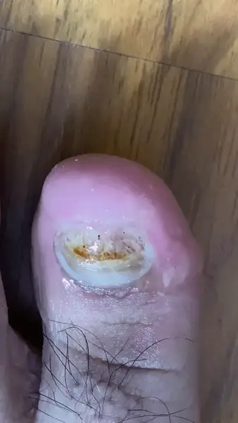Aceite Removedor de Hongos en las Uñas