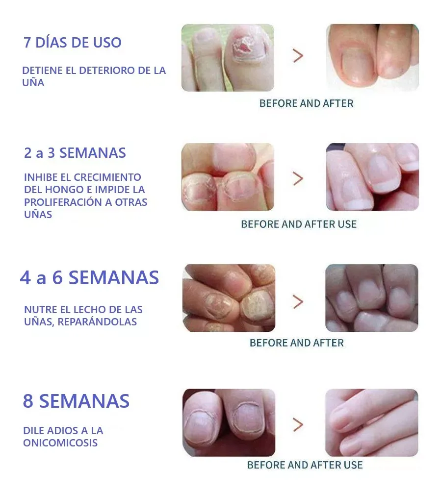 ANTI HONGOS TOENAIL PLUS - GOTERO: ¡Dile Adiós a los Hongos de Uñas! - ANTI HONGOS TOENAIL PLUS - GOTERO