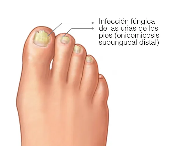 ANTI HONGOS TOENAIL PLUS - GOTERO: ¡Dile Adiós a los Hongos de Uñas! - ANTI HONGOS TOENAIL PLUS - GOTERO