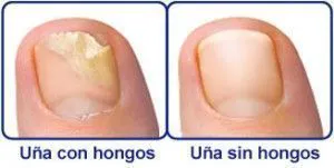 ANTI HONGOS TOENAIL PLUS - GOTERO: ¡Dile Adiós a los Hongos de Uñas! - ANTI HONGOS TOENAIL PLUS - GOTERO