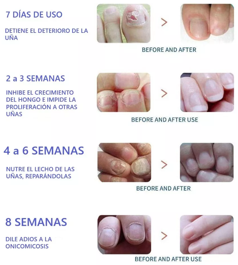 Dile Adiós a las Uñas Descoloridas y Engrosadas