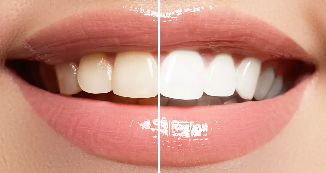 Tira Blanqueadora Dental BlancoRadiante®: ¡Sonríe con Confianza! - Tira Blanqueadora Dental x 7 Pares!!
