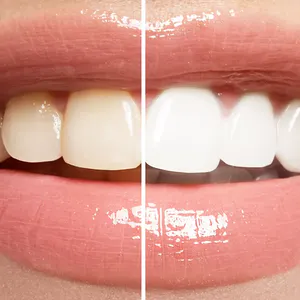 Tira Blanqueadora Dental BlancoRadiante®: ¡Sonríe con Confianza! - Tira Blanqueadora Dental x 7 Pares!!