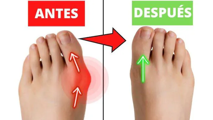 JUANETE PLASTICO 2 UND: Alivio y Corrección para Tus Pies - Corrector de juanetes X2 uds ajustables