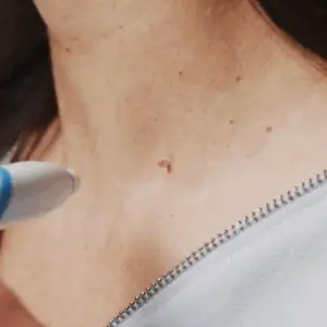 Removedor de Verrugas: ¡Dile Adiós a las Verrugas y Etiquetas Cutáneas de Forma Fácil y Segura!