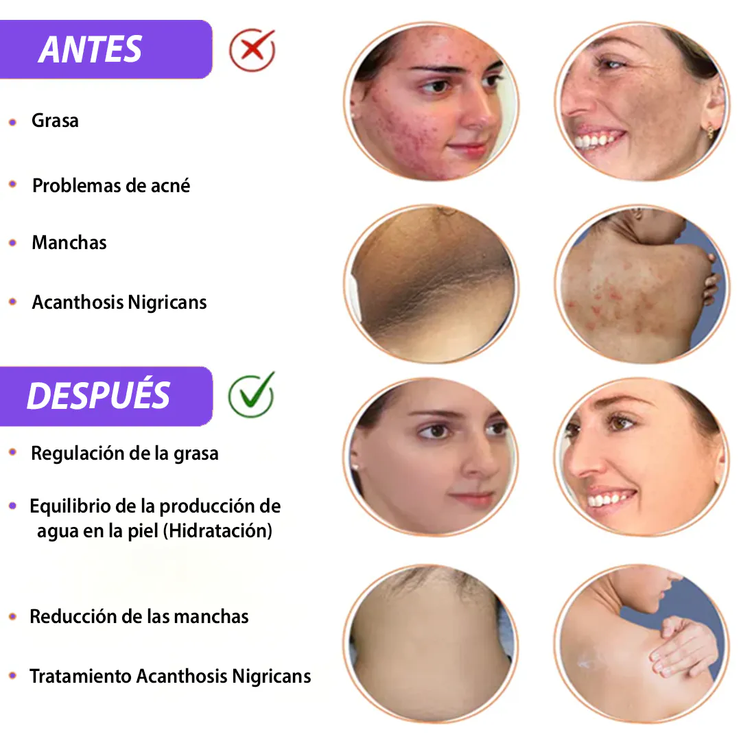 Suero Correcto de Manchas BETSKIN: Despierta la Piel Radiante que Siempre Has Soñado - Exfoliante para Manchas Oscuras