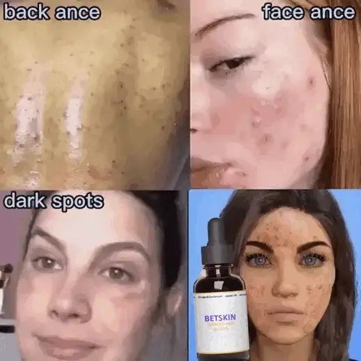 Suero Correcto de Manchas BETSKIN: Despierta la Piel Radiante que Siempre Has Soñado