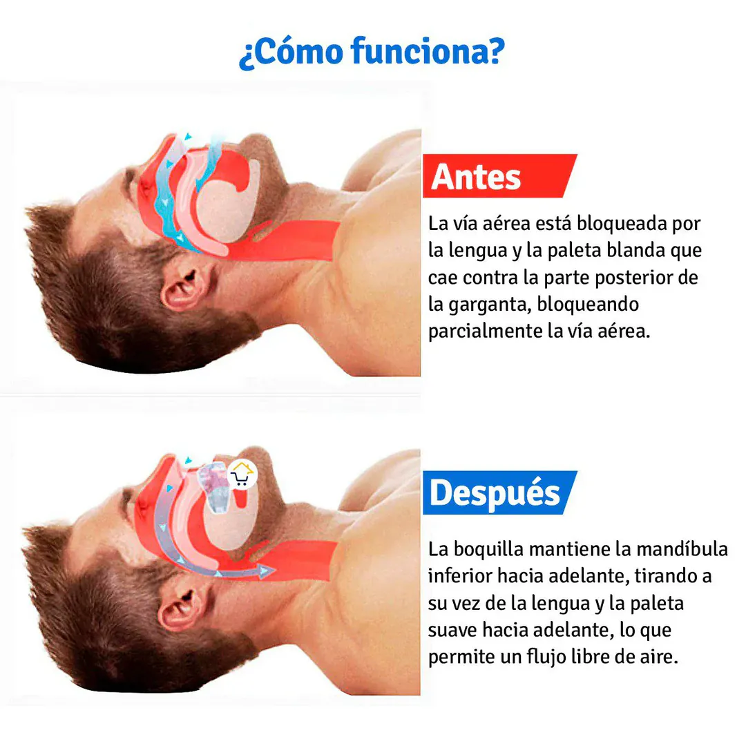 PROTECTOR BUCAL ANTIBRUXISMO: RoncaStop™ - PROTECTOR BUCAL ANTIBRUXISMO
