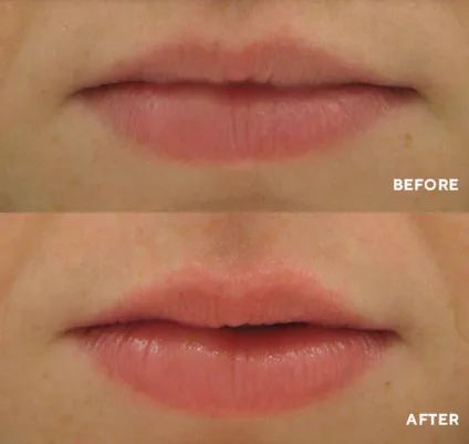 VOLUMINIZADOR DE LABIOS: Labios más llenos y sensuales al instante - VOLUMINIZADOR DE LABIOS