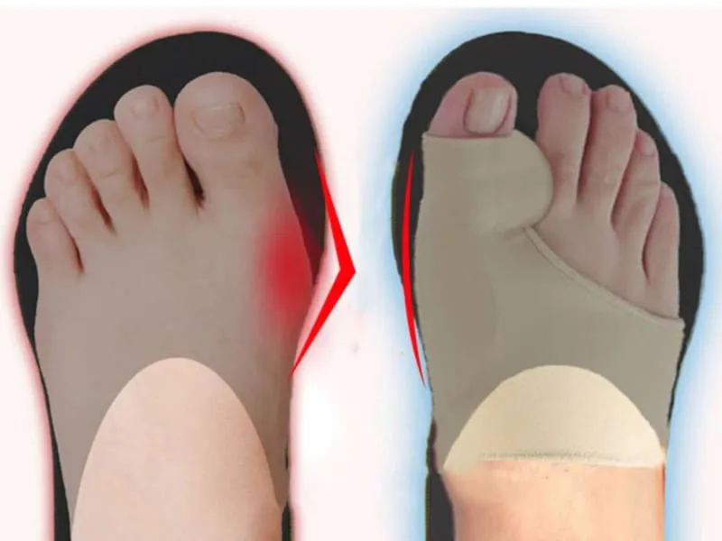 Corrector de Juanetes x2: Alivio y Comodidad para tus Pies - Corrector de juanetes x2