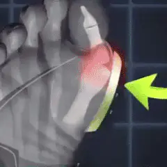 Corrector de Juanetes x2: Alivio y Comodidad para tus Pies