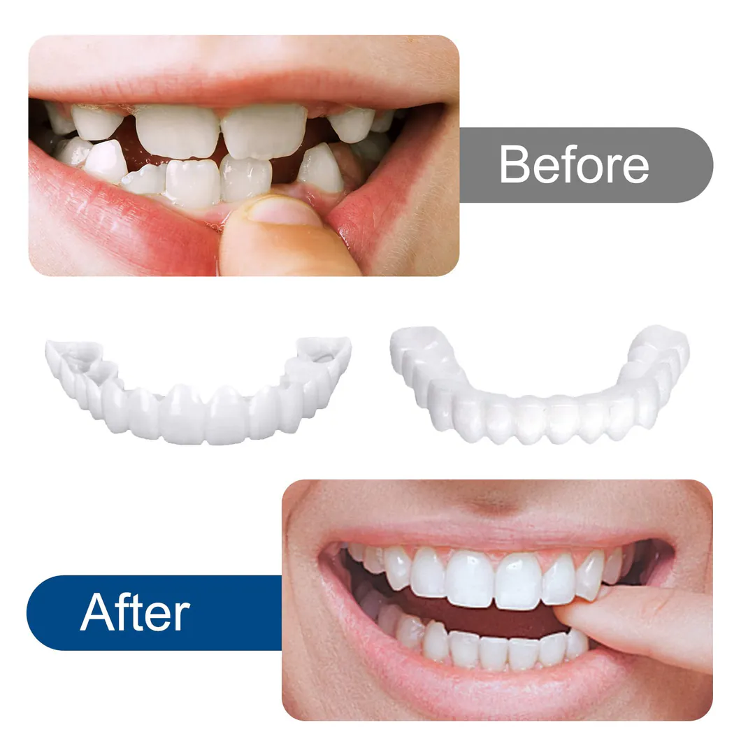 Montura Carillas Dentales Postizas: La Sonrisa Perfecta al Alcance de Tu Mano - Montura Carillas dentales postizas