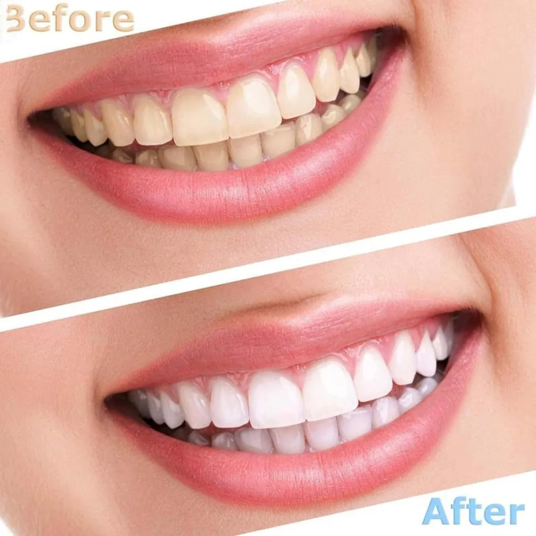 Montura Carillas Dentales Postizas: La Sonrisa Perfecta al Alcance de Tu Mano - Montura Carillas dentales postizas