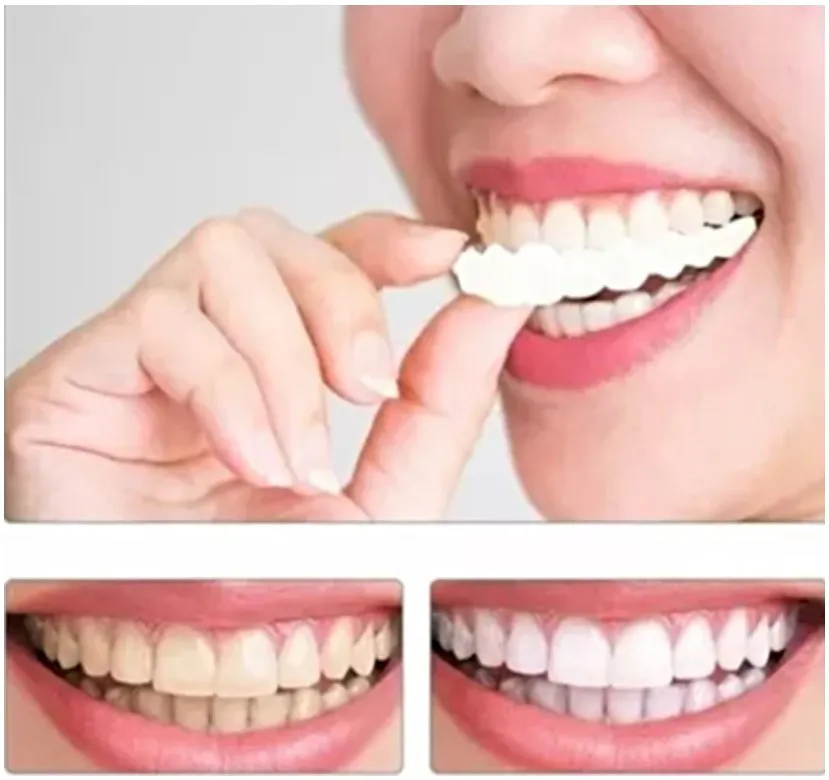 Montura Carillas Dentales Postizas: La Sonrisa Perfecta al Alcance de Tu Mano - Montura Carillas dentales postizas