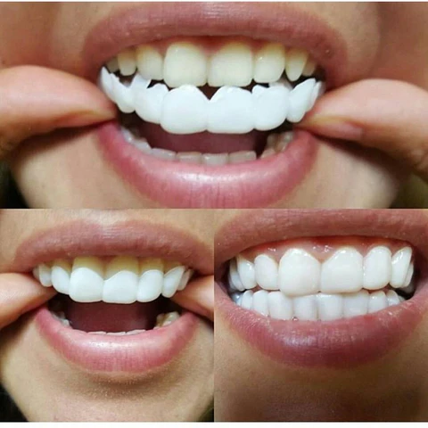 Montura Carillas Dentales Postizas: La Sonrisa Perfecta al Alcance de Tu Mano