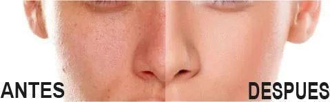 EXTRACTOR DE ESPINILLAS Y PUNTOS NEGROS: ¡Adiós Imperfecciones! - EXTRACTOR DE ESPINILLAS PUNTOS NEGROS