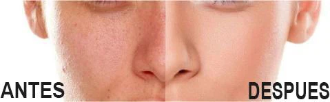 EXTRACTOR DE ESPINILLAS Y PUNTOS NEGROS: ¡Adiós Imperfecciones!