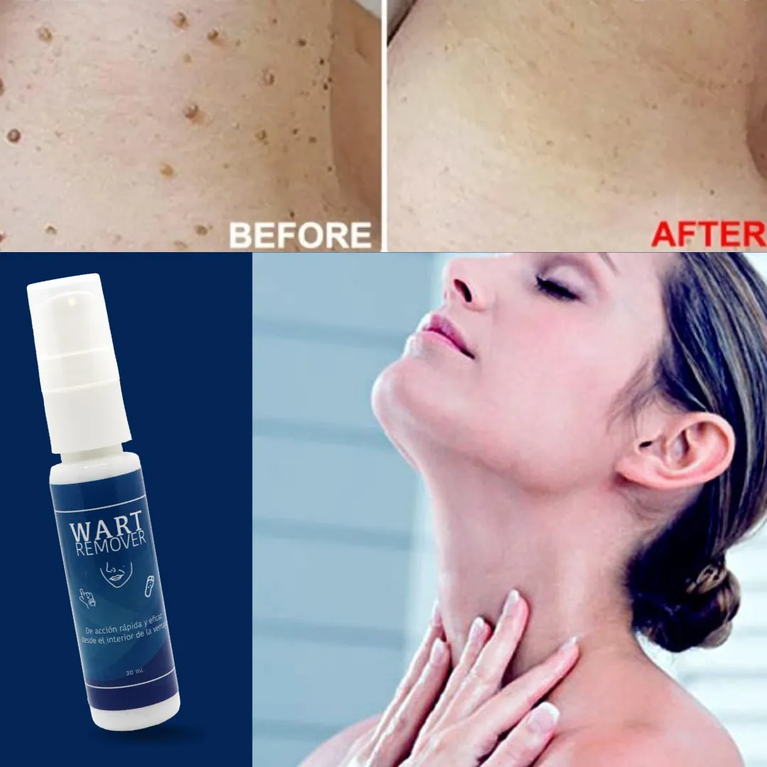 WART REMOVER AZUL X2: ¡Dile Adiós a las Verrugas para Siempre! - WART REMOVER AZUL X2