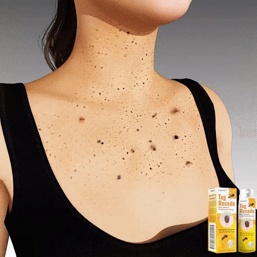 WART REMOVER AZUL X2: ¡Dile Adiós a las Verrugas para Siempre!
