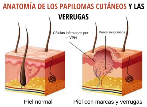 Previene la Propagación de las Verrugas