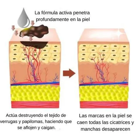 Protección Contra las Verrugas del Sol
