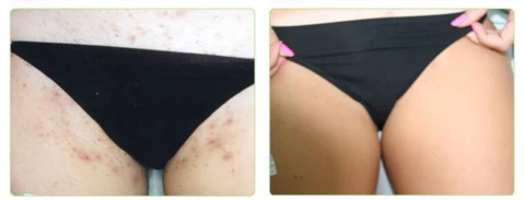 DEPILADORA LASER IPL: Despídete del Vello para Siempre