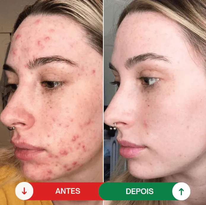 Por qué Elegir el Restaurador de Alta Frecuencia