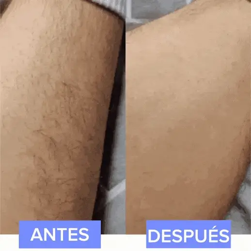 Depilador de Piedras de Cristales SILKSKIN: ¡Eliminación del Vello Indolora y Efectiva! - Depilador de Piedras de Cristales