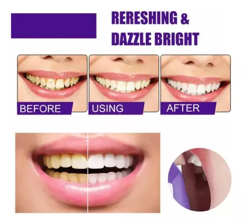 Blanqueador Dental Morada V34: ¡Sonríe con Confianza! - Blanqueador Dental Morada v34