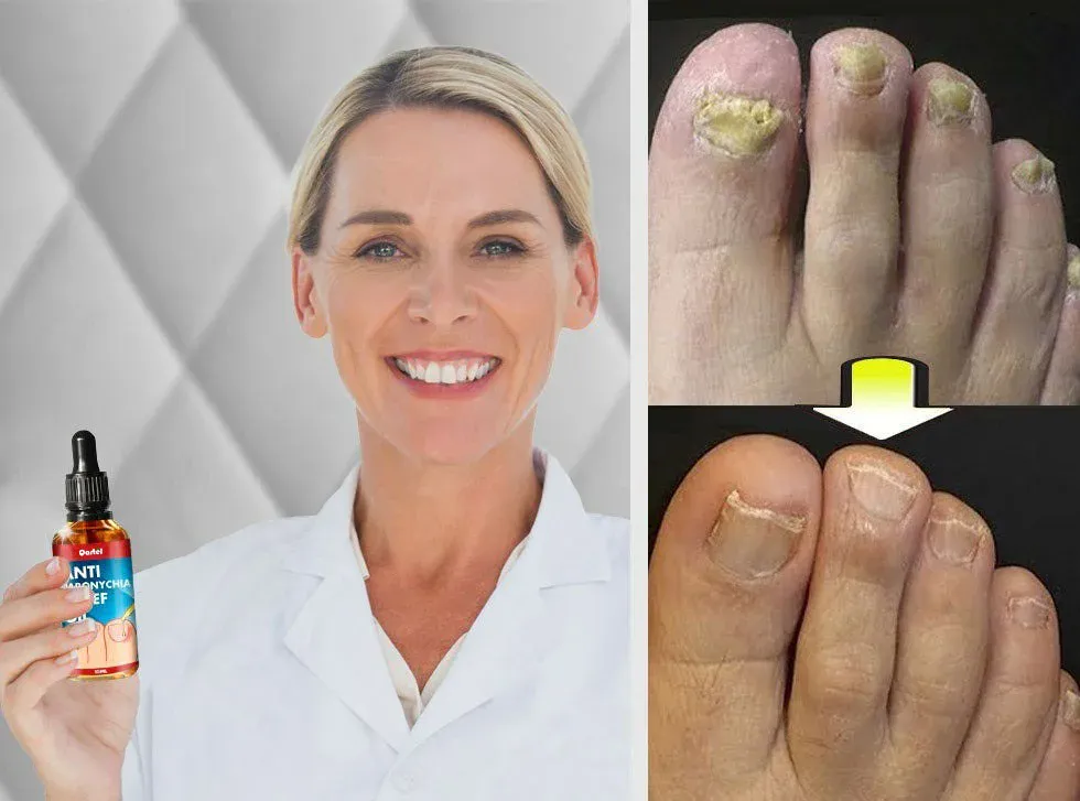 ANTI HONGO TOENAILPLUS: ¡Adiós a las uñas afectadas por hongos! - ANTI HONGO TOENAILPLUS