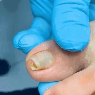 ANTI HONGO TOENAILPLUS: ¡Adiós a las uñas afectadas por hongos! - ANTI HONGO TOENAILPLUS