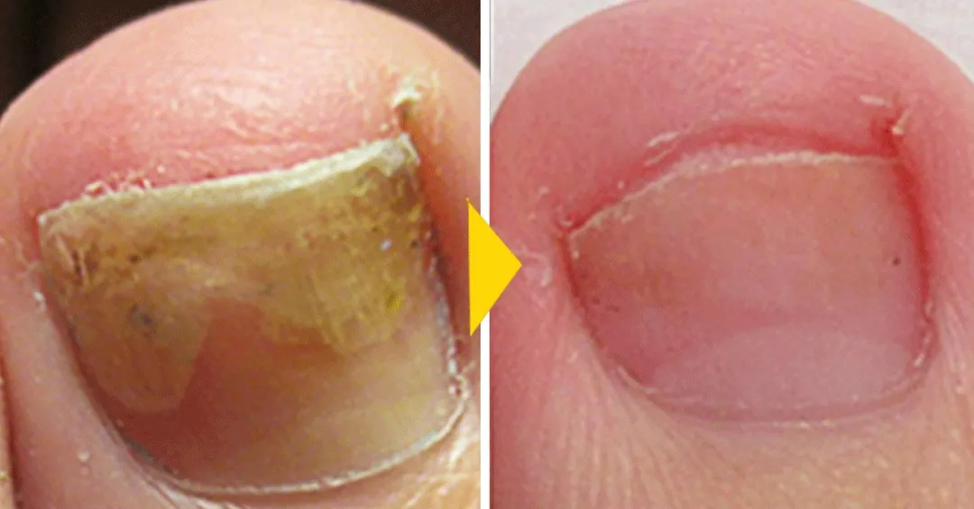 ANTI HONGO TOENAILPLUS: ¡Adiós a las uñas afectadas por hongos! - ANTI HONGO TOENAILPLUS