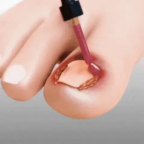 ANTI HONGO TOENAILPLUS: ¡Adiós a las uñas afectadas por hongos!