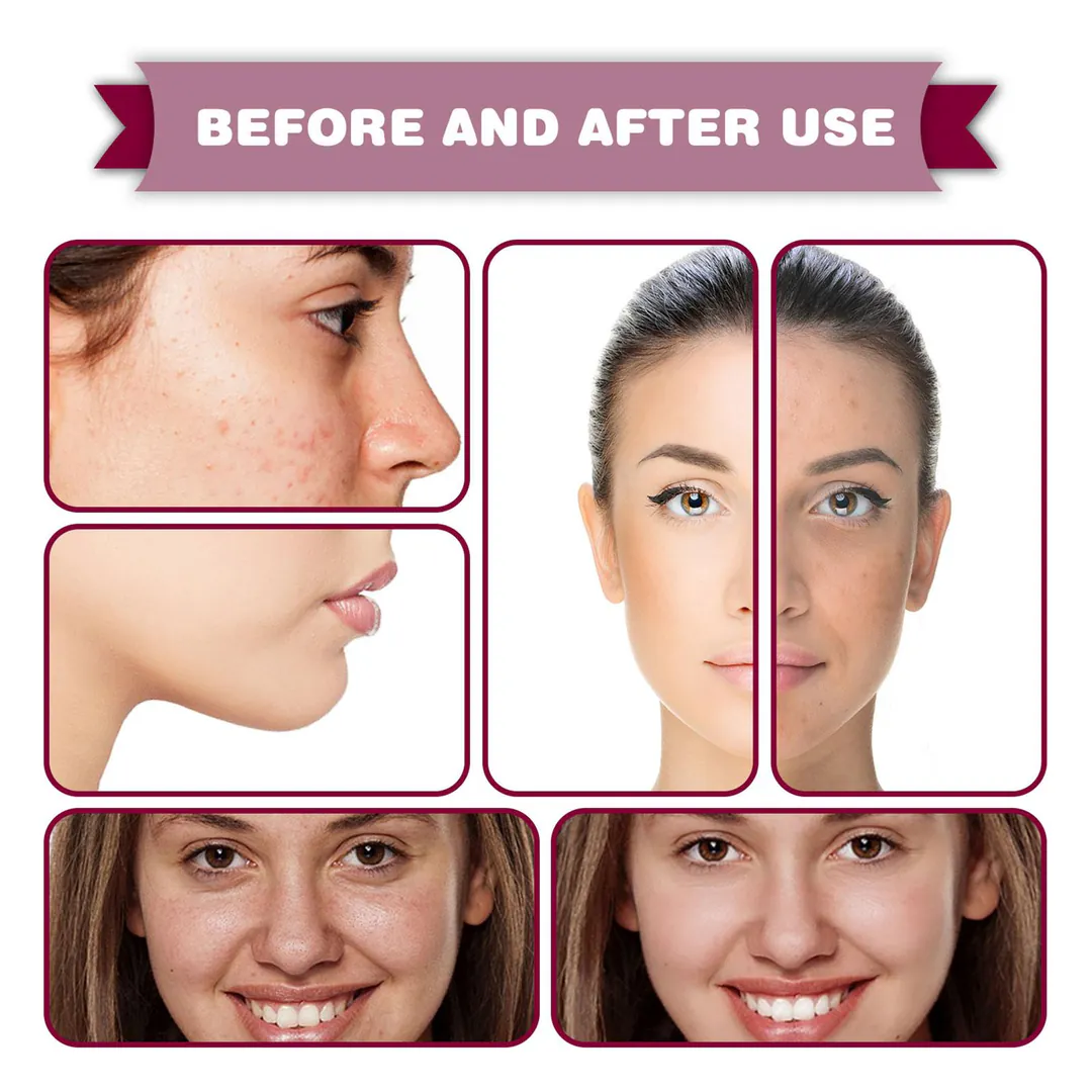 Tratamiento Definitivo para el Acné: ¡Dile Adiós a las Imperfecciones! - Tratamiento definitivo Acné