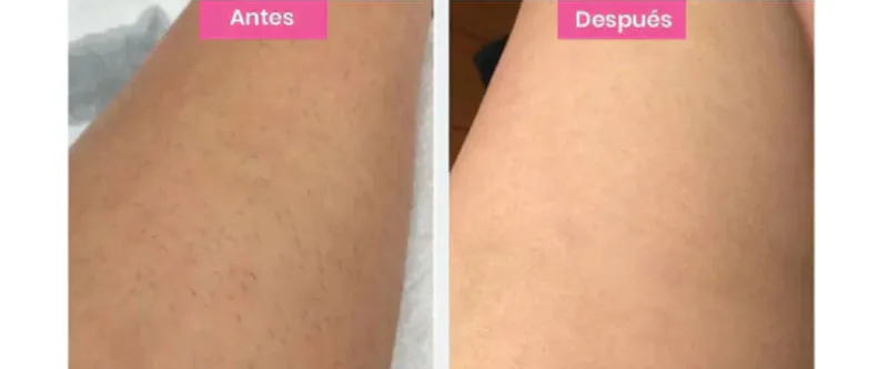 Tecnología IPL Avanzada