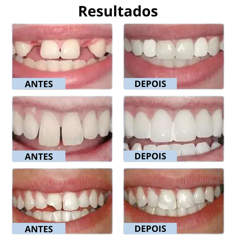 Beneficios del Moldeador para Dientes