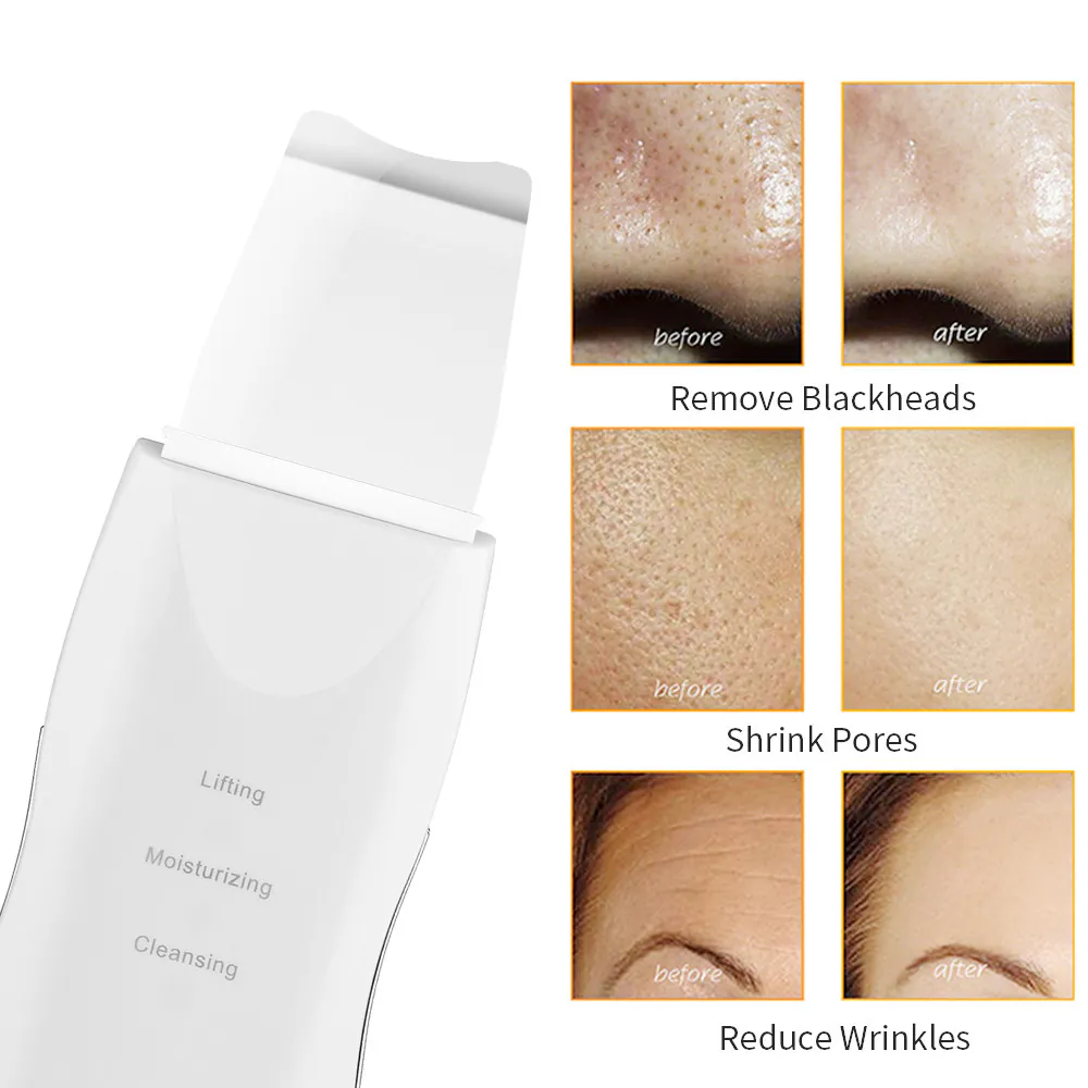 Peeling Ultrasónico Facial: La Clave para una Piel Radiante - Peeling Ultrasónico Facial