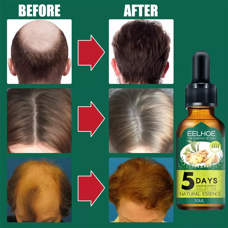 KING OF GINGER: ¡El secreto para un cabello y una barba más exuberantes! - KING OF GINGER CRECER EL PELO Y BARBA